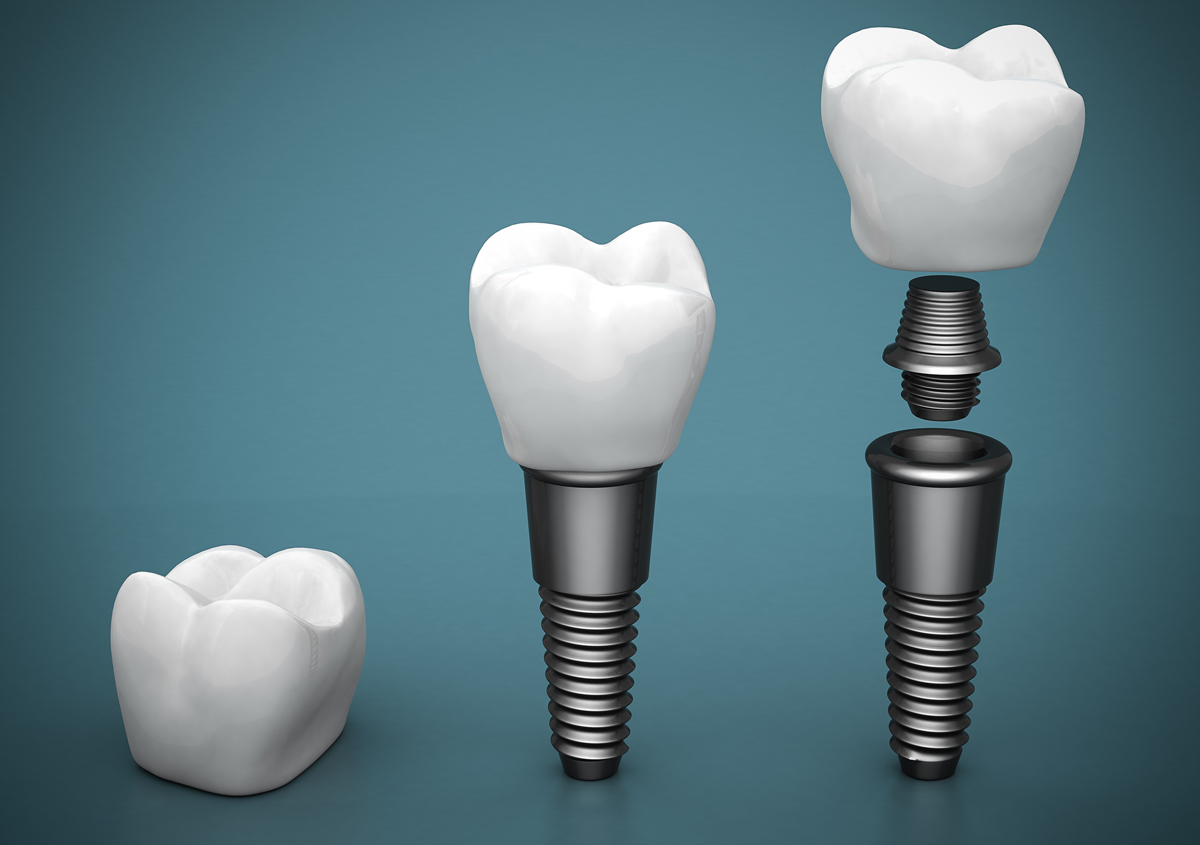 Dental Implants River Oaks