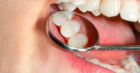 Tooth-colored cavity fillings in NYC by City Dental Group NYC